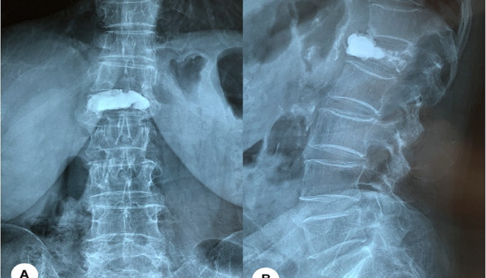 The Role of Bone Cement